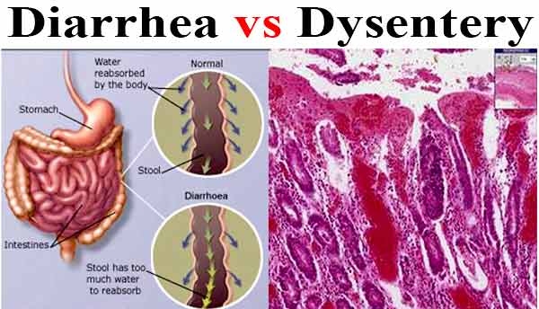 Diferencias entre diarrea y disentería