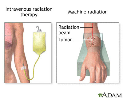 radiación-dolor